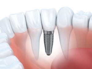 Dental Implants West Loop Chicago, IL